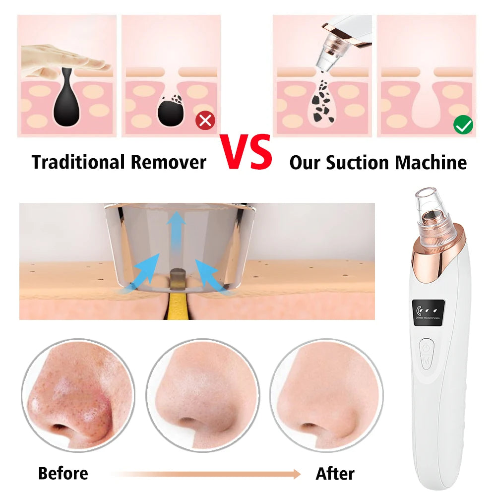 Blackheads Removing Machine