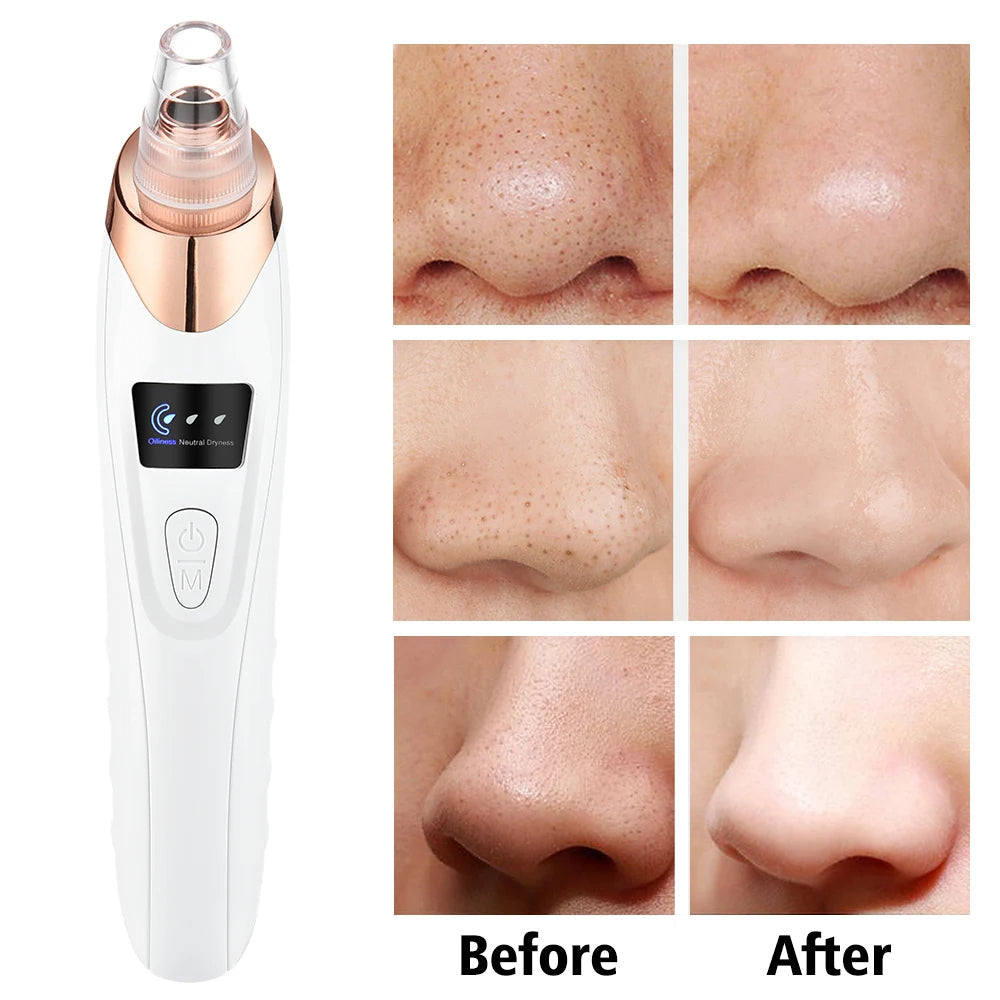 Blackheads Removing Machine